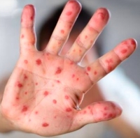 Morbillo, la Asl conferma i casi